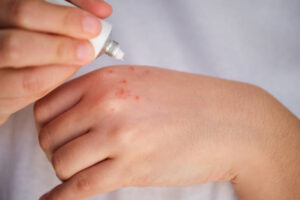 crème contre l'eczéma