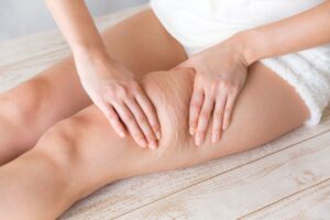 cellulite des cuisses